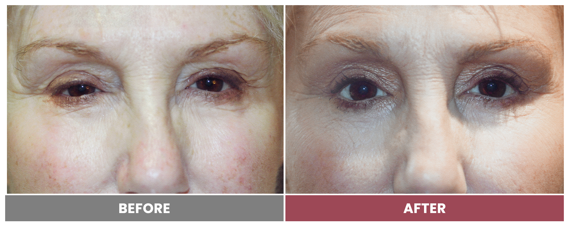 PTOSIS REPAIR - Case 58